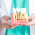 Everything You Need to Know About Mono Dental Implants
