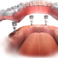 Are You Awake During Dental Implant Surgery? - An Expert's Perspective