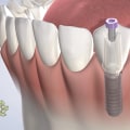 What Type of Aftercare is Needed for a Mono Dental Implant?