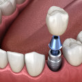 What is the Most Common Cause of Dental Implant Failure? A Comprehensive Guide