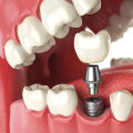 Recovering from a Mono Dental Implant: What to Expect and How to Prepare