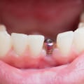 How Long Does It Take to Heal After Getting a Mini Dental Implant?