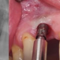 Can a Mono Dental Implant Be Removed? - A Comprehensive Guide