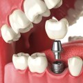 What is the Cost of a Mini Dental Implant?