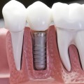 Can I Get a Dental Implant After Orthodontic Treatment?