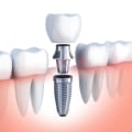 5 Essential Tips for Caring for Your Gums After Getting a Dental Implant