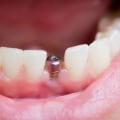 What to Know About Dental Implant Recovery