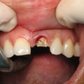 How Long Does it Take for Dental Implants to Fully Settle?
