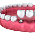 Can Multiple Teeth Be Replaced with a Mono Dental Implant?