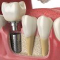 Does Insurance Cover the Cost of a Mono Dental Implant Procedure?