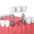 Can Mono Dental Implants Replace All Teeth in One Arch?