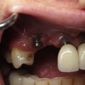 How to Avoid Dental Implant Failure
