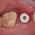 How Long Does a Monodental Implant Last? A Comprehensive Guide