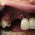 What to Do When a Dental Implant Fails: A Comprehensive Guide