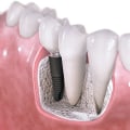Can I Get a Dental Implant After Periodontal Treatment? - An Expert's Perspective