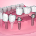 What are the Most Common Causes of Dental Implant Failure? A Comprehensive Guide