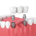 What Materials are Used for a Mono Dental Implant?