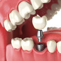Can a Mono Dental Implant be Replaced?