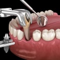 Can I Get a Dental Implant After Tooth Extraction? - A Comprehensive Guide