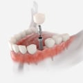 What Type of Anesthesia is Used for a Mono Dental Implant Procedure?