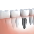 Can Diabetics Get Dental Implants? An Expert's Guide to Safely Replacing Missing Teeth