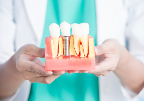 Everything You Need to Know About Mono Dental Implants