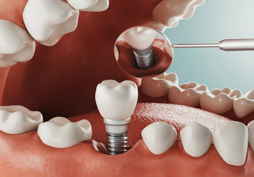 Exploring Your Options: Alternatives to a Mono Dental Implant