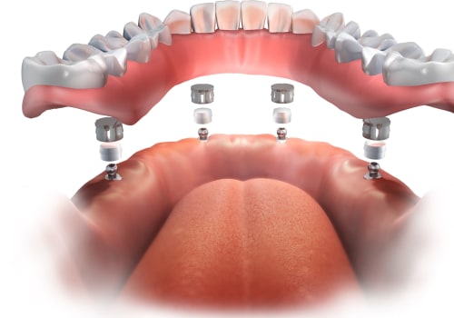 Are You Awake During Dental Implant Surgery? - An Expert's Perspective