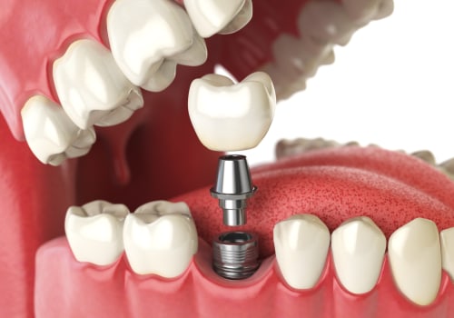 Recovering from a Mono Dental Implant: What to Expect and How to Prepare