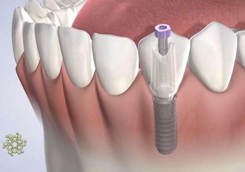 Caring for Your Teeth After a Mono Dental Implant: A Guide to Proper Care