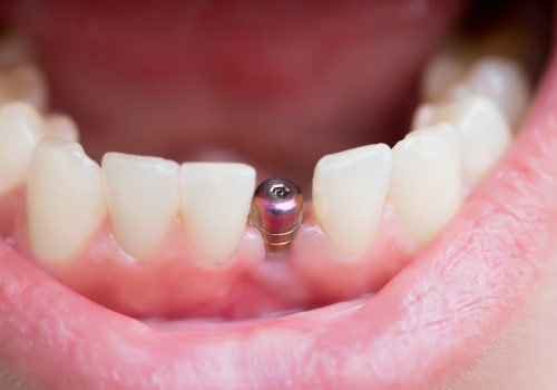 How Long Does It Take to Heal After Getting a Mini Dental Implant?