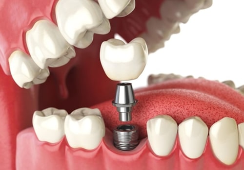 What is the Cost of a Mini Dental Implant?