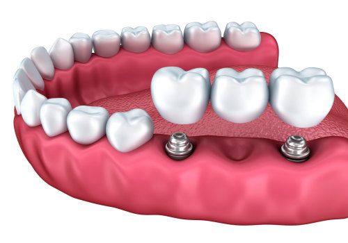 Can Multiple Teeth Be Replaced with a Mono Dental Implant?