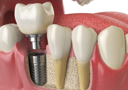 Does Insurance Cover the Cost of a Mono Dental Implant Procedure?