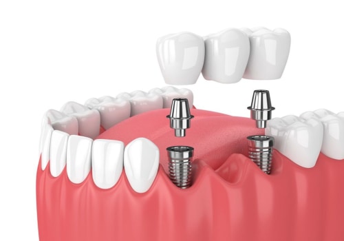 Can Mono Dental Implants Replace All Teeth in One Arch?