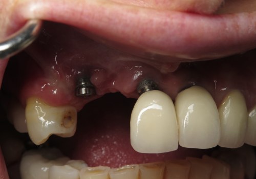 How to Avoid Dental Implant Failure