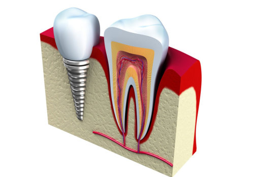 Can I Get a Dental Implant After a Failed Root Canal Treatment?