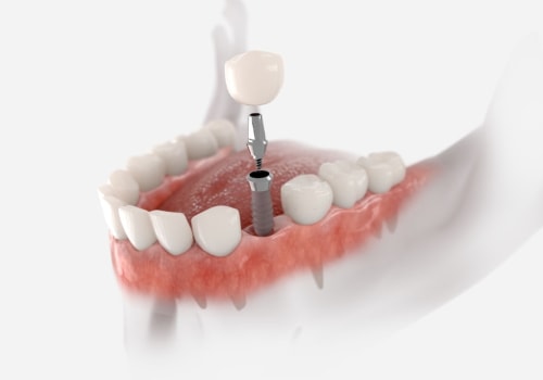 What to Know Before Getting a Mono Dental Implant