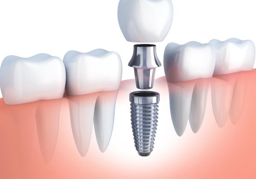 What Type of Follow-Up Care is Needed After a Mono Dental Implant Procedure?