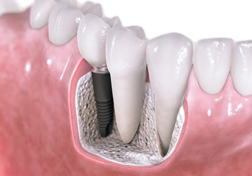 Can I Get a Dental Implant After Periodontal Treatment? - An Expert's Perspective