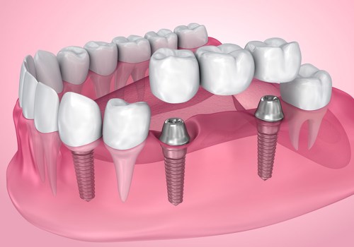 What are the Most Common Causes of Dental Implant Failure? A Comprehensive Guide