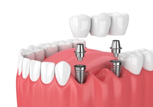 What Materials are Used for a Mono Dental Implant?