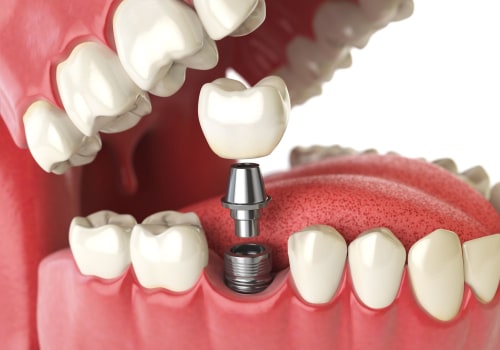 Can a Mono Dental Implant be Replaced?