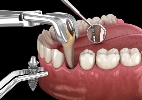 Can I Get a Dental Implant After Tooth Extraction? - A Comprehensive Guide
